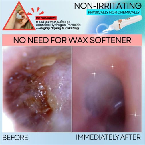 🔥Hot Sale🔥 Earwax Vacuum – Safe & Painless Ear Cleaning for the Whole Family